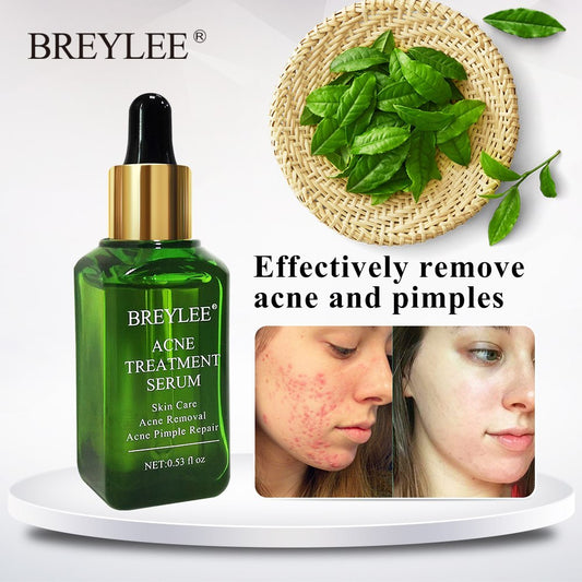 BREYLEE Acne Treatment Serum Face Facial Anti Acne Scar Removal Cream Skin Care Whitening Repair Pimple Remover For Acne amna